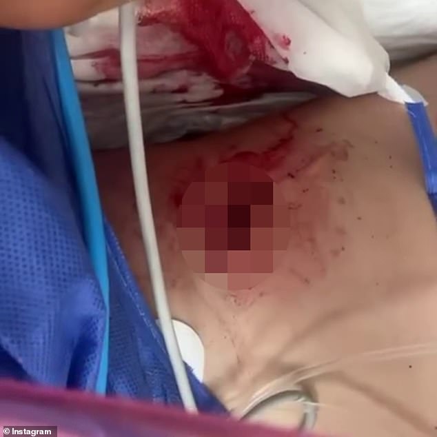 Aussie Olympic cyclist Luke Plapp has revealed the Games' most gruesome injury (pictured) after he was involved a horror incident during the time trials in Paris that left him needing abdominal surgery