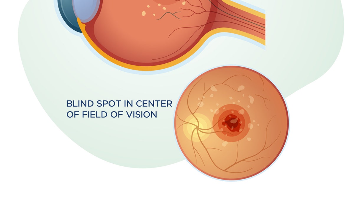 Wet macular degeneration