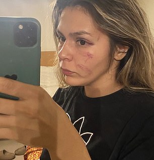 Mexican fighter Brianda Tamara displaying her injuries from the fight with Khelif in 2022